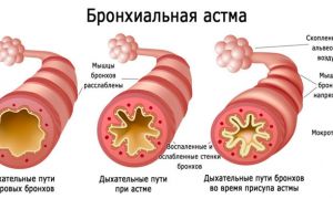 Бронхиальная астма. Лечение народными средствами