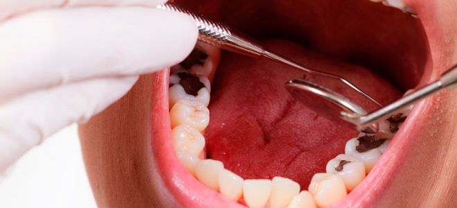 Лечение кариеса зубов: стоматология