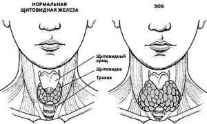 Диффузно-узловой зоб щитовидной железы