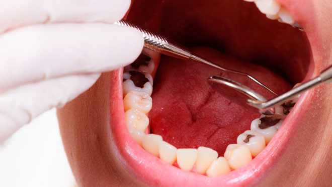 Лечение кариеса зубов: стоматология