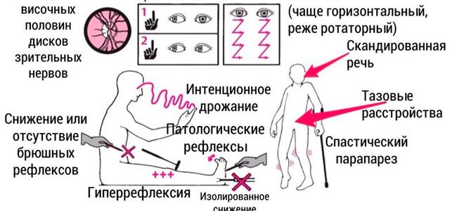 Как лечить рассеянный склероз